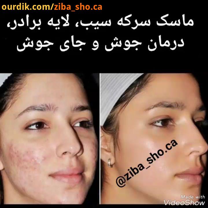 .ماسک صورت سرکه سیب لایه بردار، رفع جوش جای جوش خوب ، بعد از اینکه روشهای مراقبت از پوستهای با منا