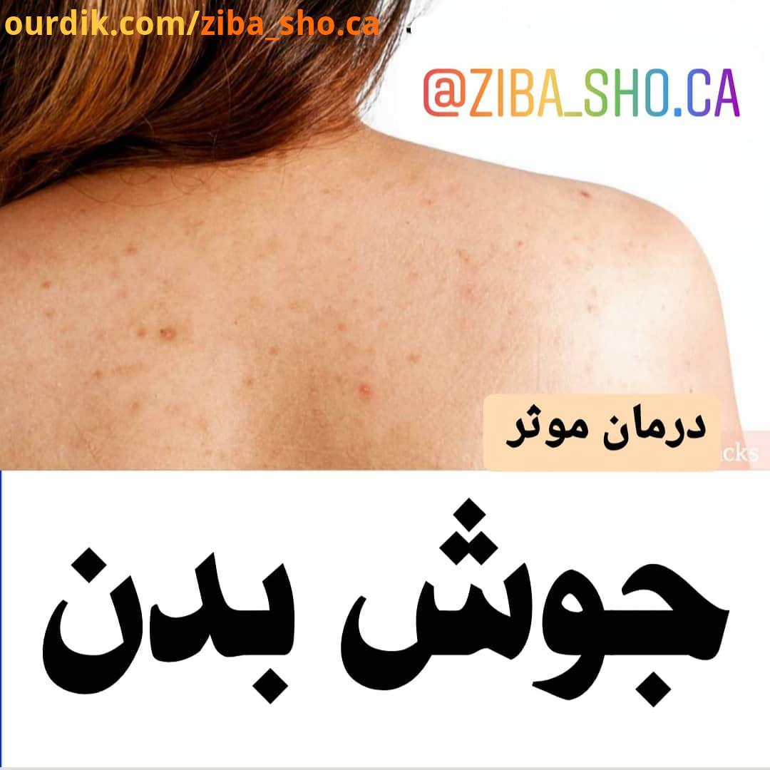 مرسی که امیدوارم این درمان مفید باشه ، نظراتتون رو بنویسید.