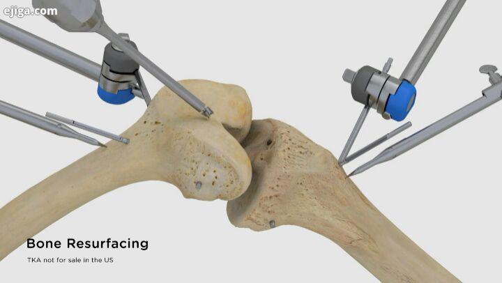 جراحی تعویض کامل مفصل زانو با یک ربات ربات TSolution One تاییدیه سازمان غذا دارو را کسب کرد این رب