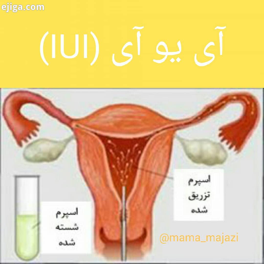 نکاتی در رابطه با آی یو آی: آی یو آی تلقیح درون رحمی در دو صورت به کار می رود: اول: ناباروری مر