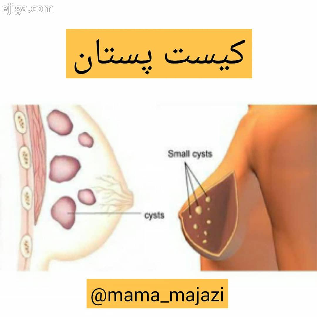کیست پستان شایع ترین ضایعه پستان است که بیشتر در خانم های 35 50 سال دیده می شوند معمولا بعد از یائ