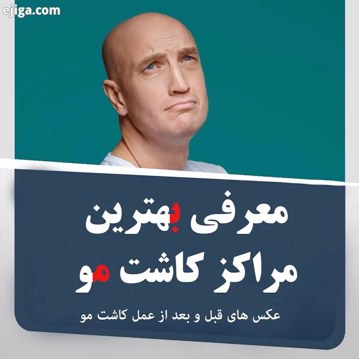 معرفی بهترین مجرب ترین مراکز کاشت مو بهترین مناسب ترین روش کاشت مو روز دنیا برگرفته از آخرین روش