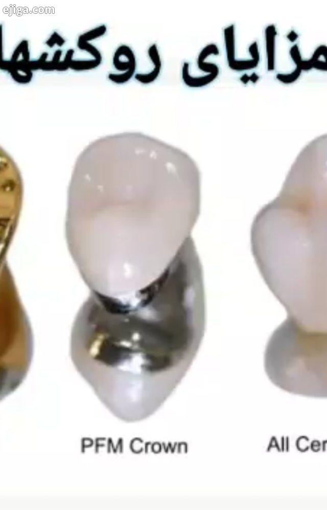 روکش دندان راه حلی مناسب برای مشکلات دندانی است مثل: از دندانی حمایت می کند که به طور قابل توجهی پوس