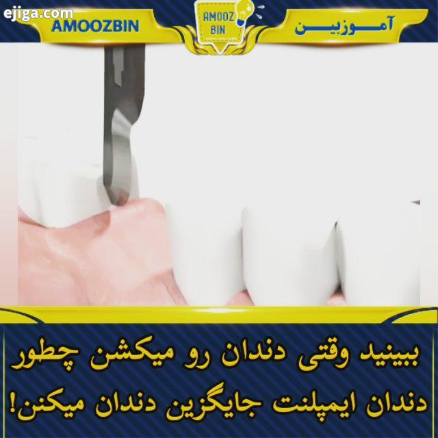ببینید وقتی دندان رو میکشیم دندانی که جایگزین دندان اصلی میشه به چه صورت انجام میشه دندان دندانپزش