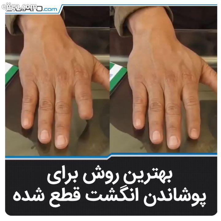 انگشت مصنوعی ای که کارایی یک انگشت واقعی را دارد انگشت مصنوعی