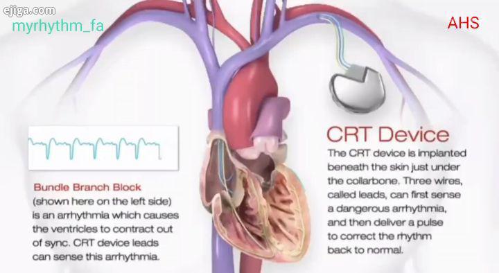 توضیح دستگاه CRT یا پیس میکر دو بطنی برگرفته از سایت American heart association هولترهای قلب مای ریت