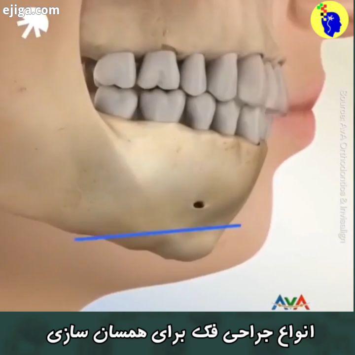 کسی تا حالا این جراحی رو کرده unknown جراحی پزشکی فناوری بدن انسان شبیه سازی فک جراحی صورت جراحی فک